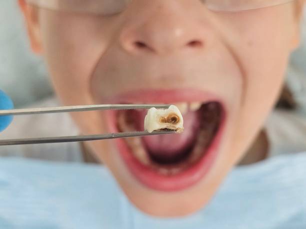 Best Emergency Wisdom Teeth Removal in Shavano Park, TX
